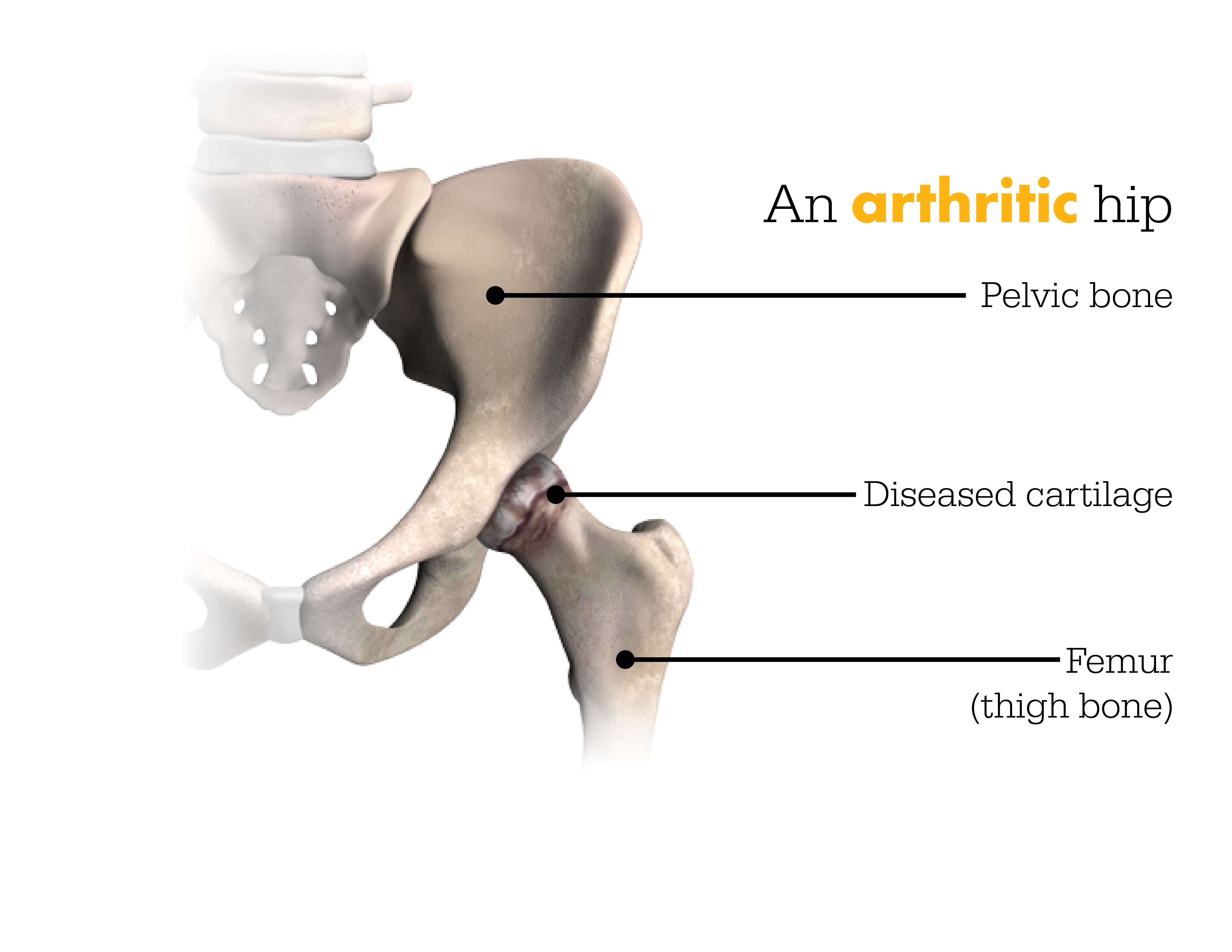 Mako Robotic-Arm Assisted Technology for Total Hip Replacement